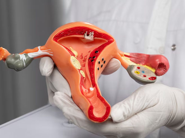 Fibroids & Endometrial Polyps Treatment Meerut