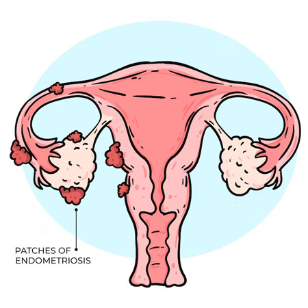 Understanding Endometriosis