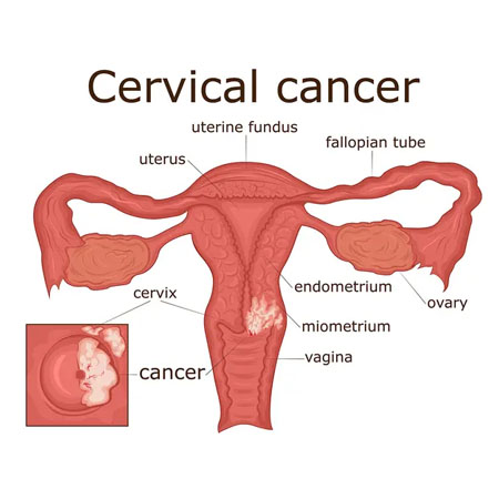 Cervical Cancer treatment Meerut