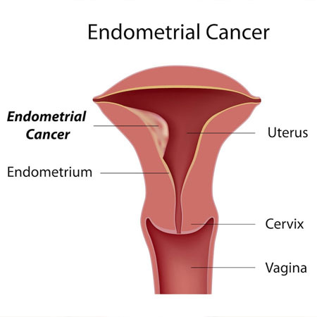Endometrial Cancer treatment Meerut