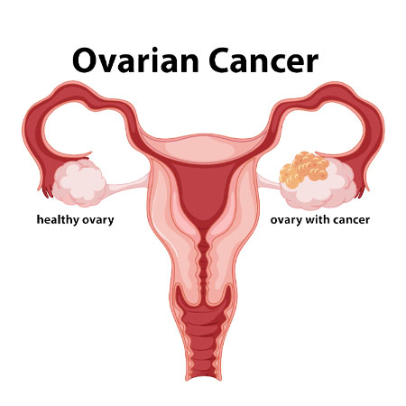 Ovarian Cancer treatment Meerut