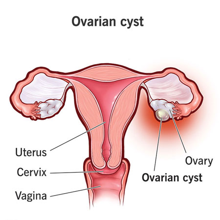 Ovarian Cysts treatment Meerut