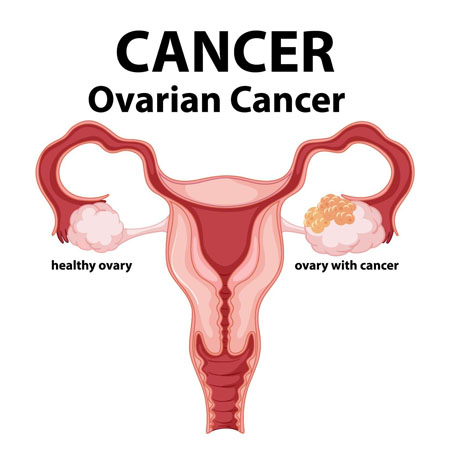Ovarian Tumors treatment Meerut