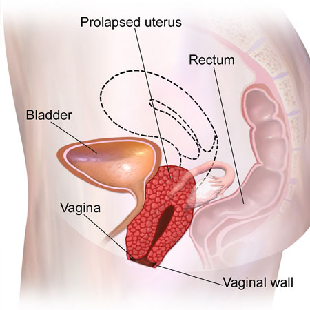 Pelvic Organ Prolapse treatment Meerut