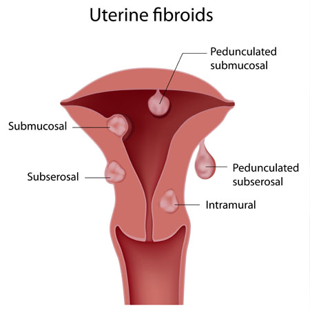 Uterine Fibroids treatment Meerut
