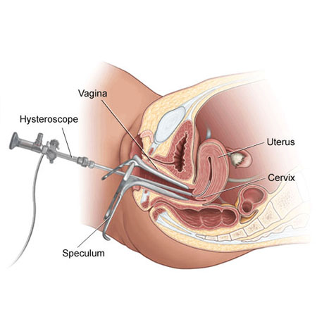 Hysteroscopic Polypectomy & Septum Resection Specialist Meerut