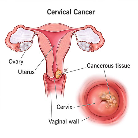 Cervical Cancer: Laparoscopic Radical Hysterectomy Meerut