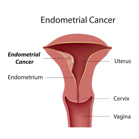 Endometrial Cancer: Laparoscopic Hysterectomy & Staging Meerut
