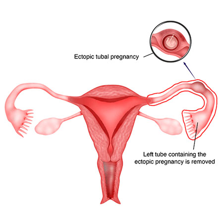 Laparoscopic Ectopic Pregnancy Specialist Meerut