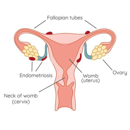 Laparoscopic Endometriosis Specialist Meerut
