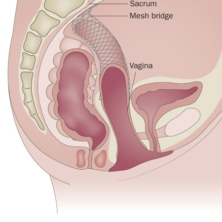 Laparoscopic Prolapse & Vault Suspension Specialist Meerut